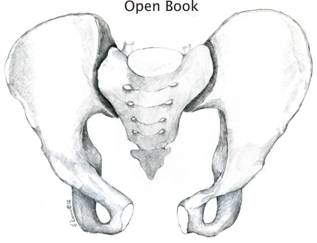 What are open book pelvic fractures?